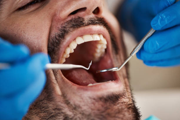 Best Knocked-Out Tooth (Avulsed Tooth) Treatment in Big Lake, MN